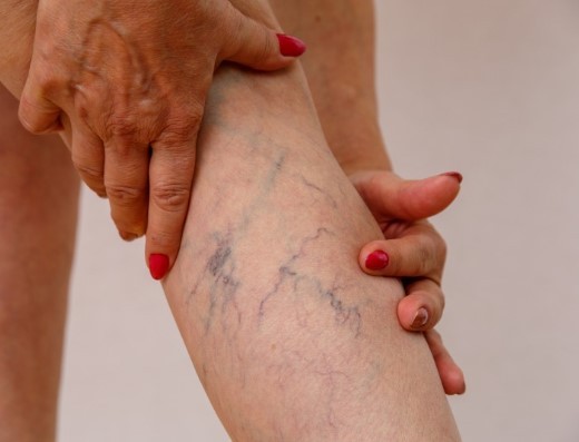 Vein